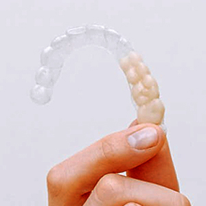 Is Invisalign Treatment Right Choice for You?